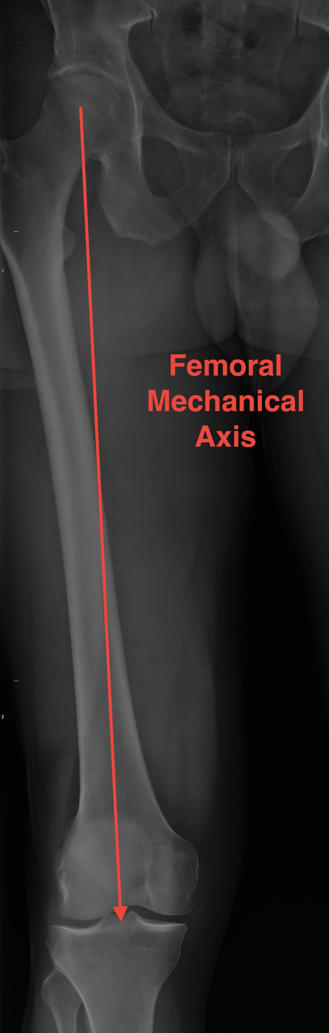 Femoral Mechanical Axis